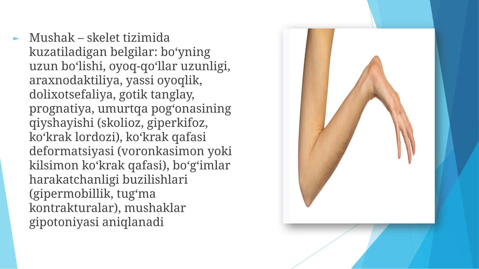 Marfan kasalligi 3