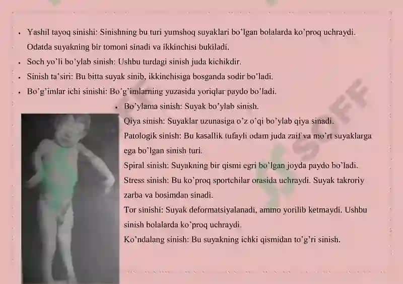 Suyak sinishining turlari 3