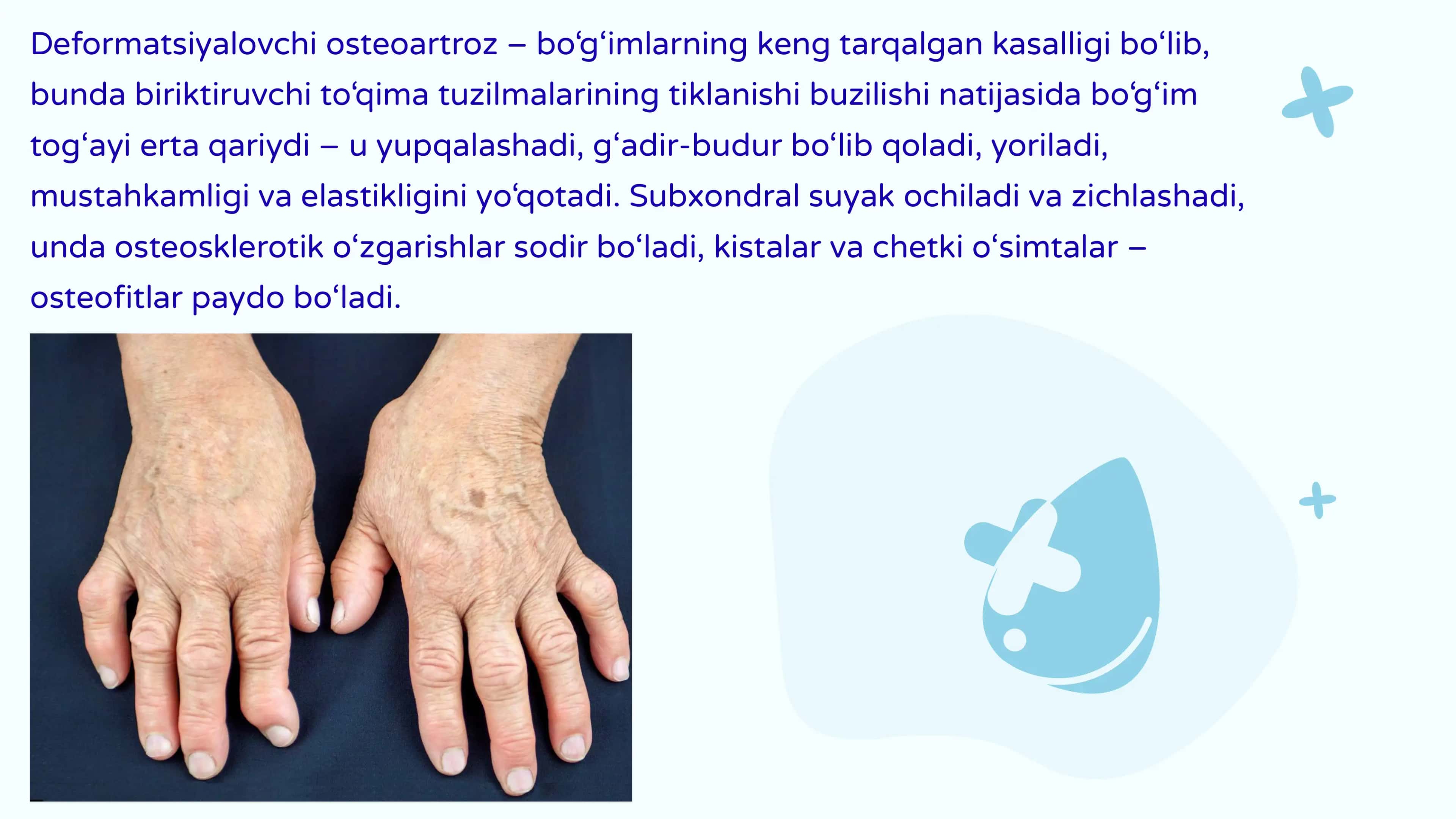 Deformatsiyalovchi osteoartroz 3