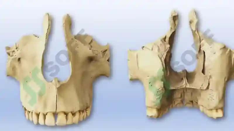Yuqori jag‘ anatomiyasi Maxilla 5