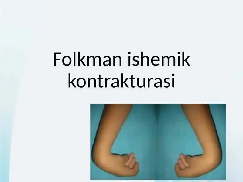 Folkman ishemik kontrakturasi 1
