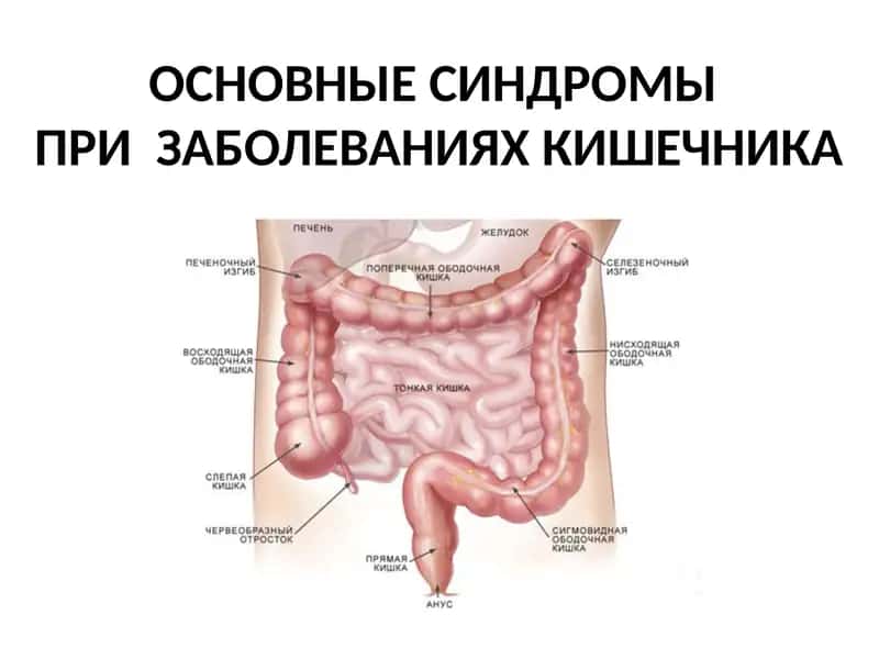 ОСНОВНЫЕ СИНДРОМЫ ПРИ  ЗАБОЛЕВАНИЯХ КИШЕЧНИКА 1