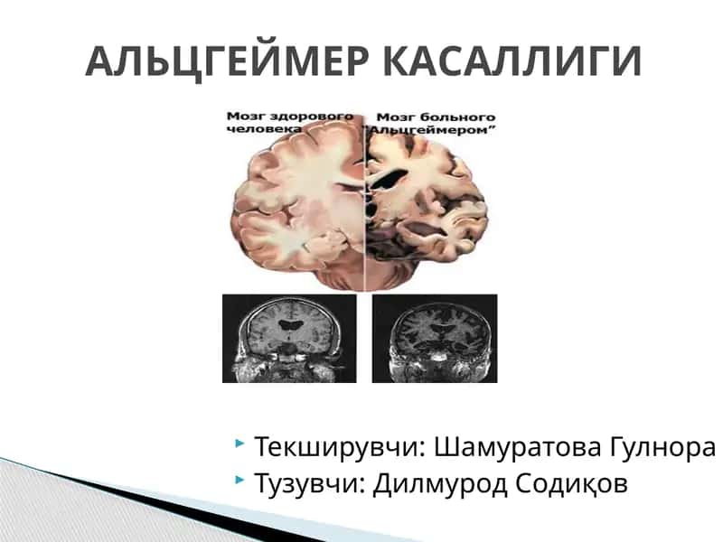 АЛЬЦГЕЙМЕР КАСАЛЛИГИ 1