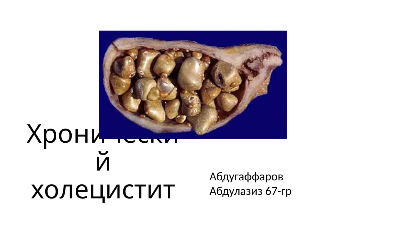 Хронический холецистит 1