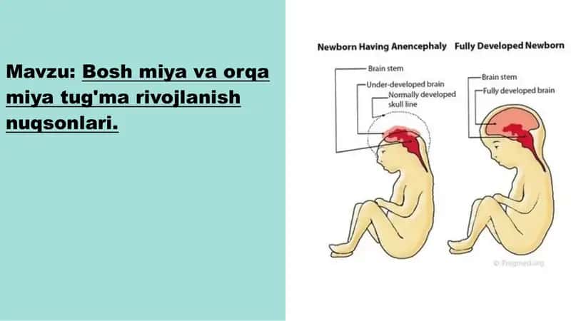 Bosh miya va orqa miya tug'ma rivojlanish nuqsonlari 1