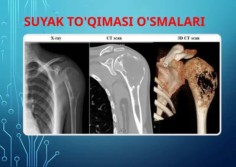 Suyak to'qimasi o'smalari 1