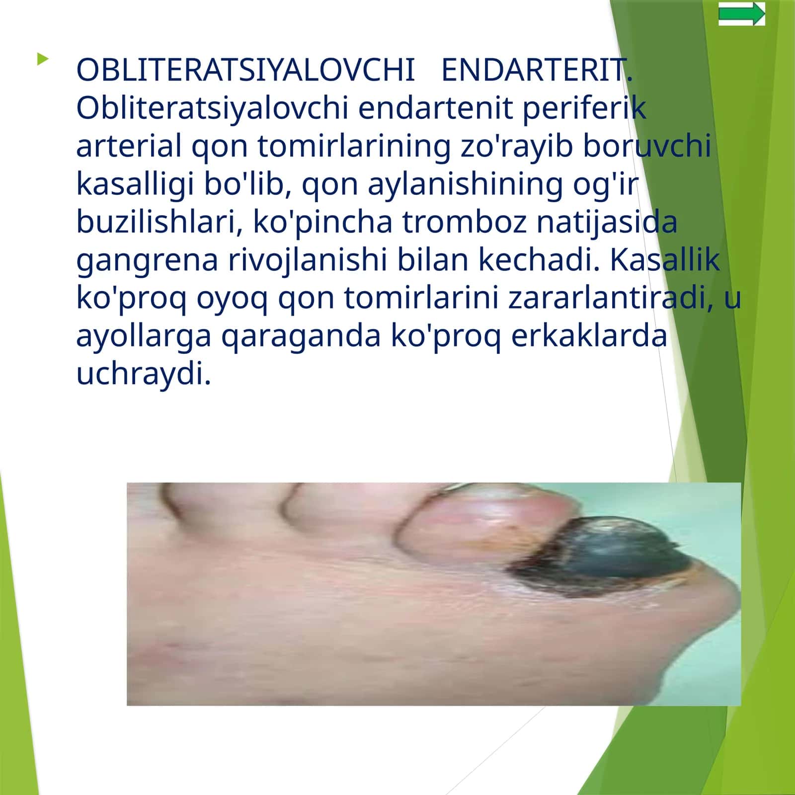Obliteratsiyalovchi Endarterit 1
