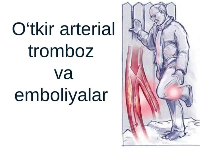 O‘tkir arterial tromboz va emboliyalar 1