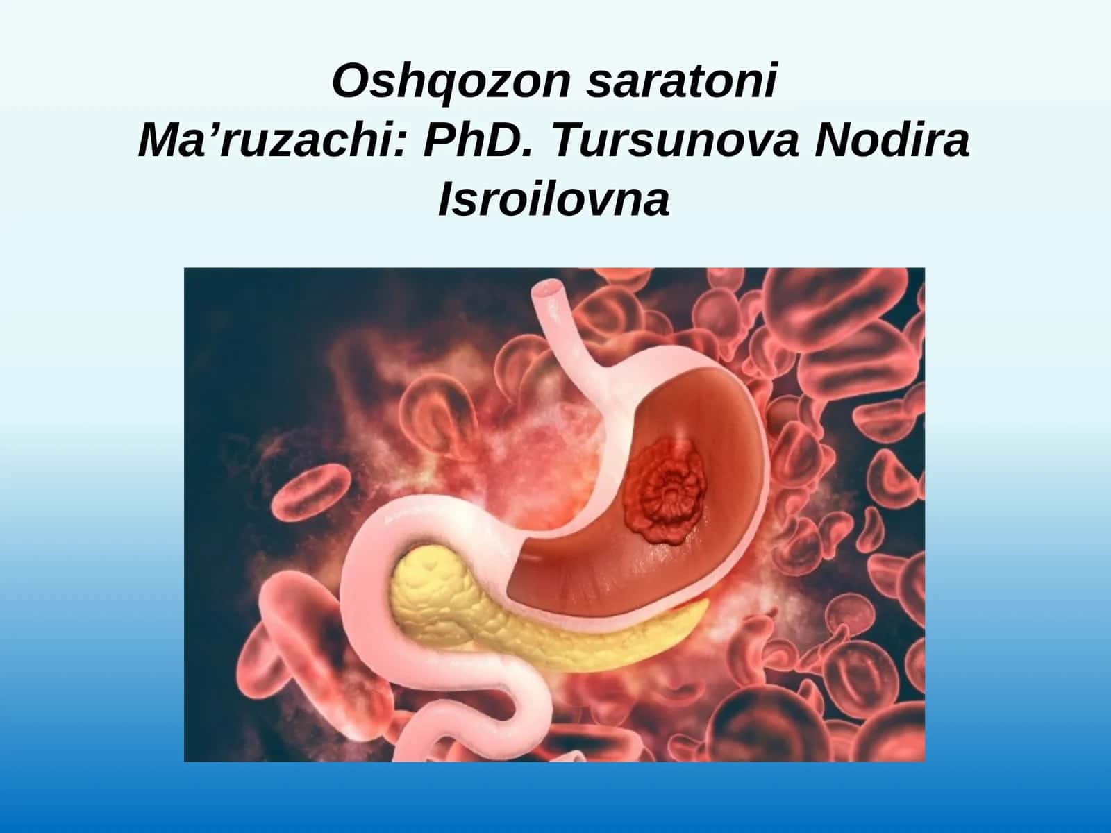 Oshqozon saraton 1
