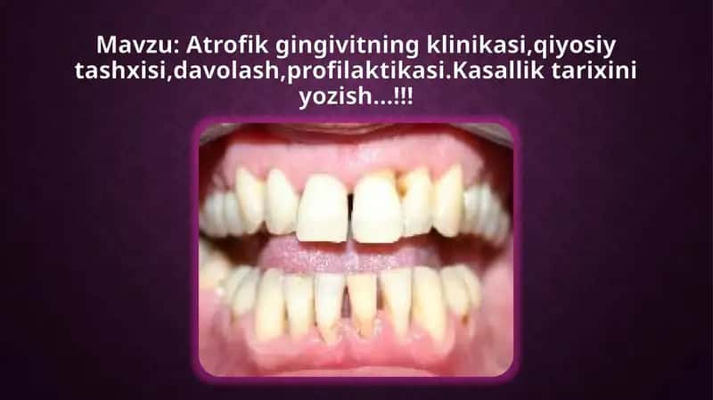 Atrofik gingivitning klinikasi 1