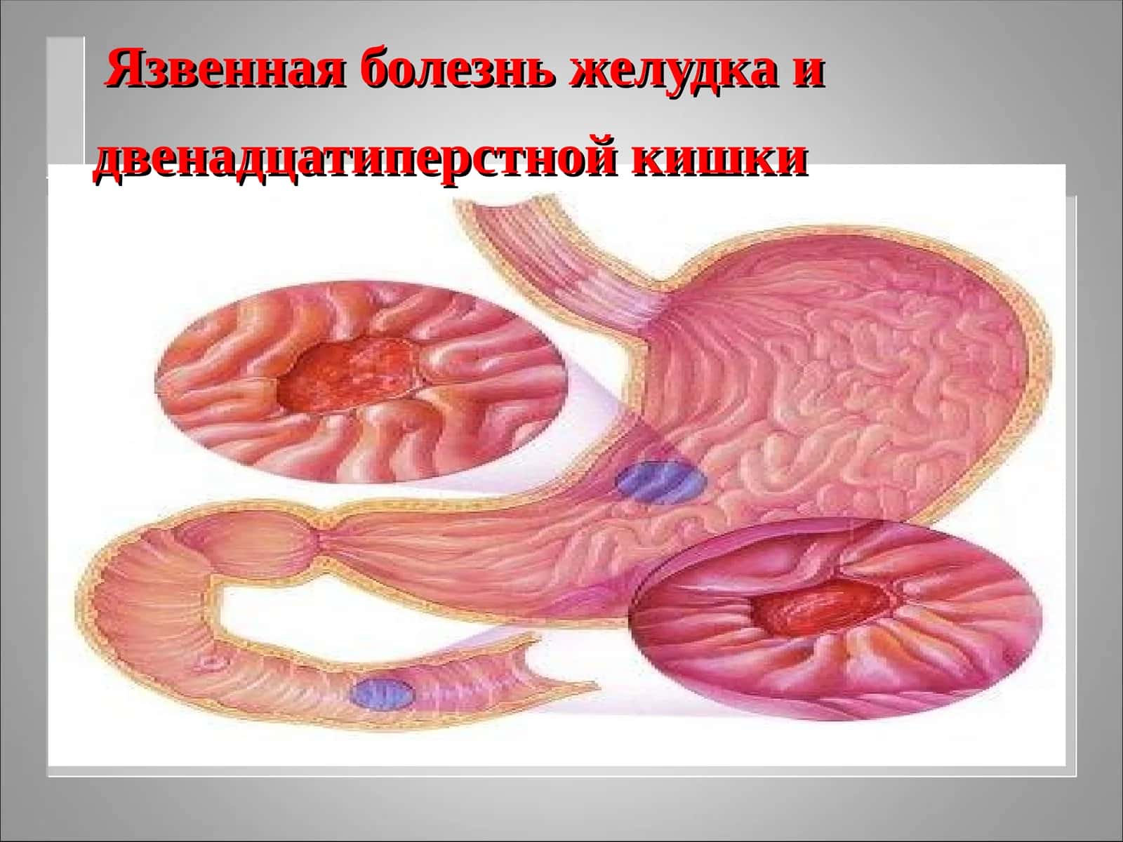 Язвенная болезньжелудка и двенадцатиперстной кишки 1