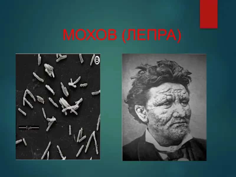 МОХОВ (ЛЕПРА) 1