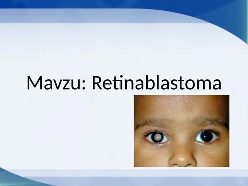 Retinablastomalar 1