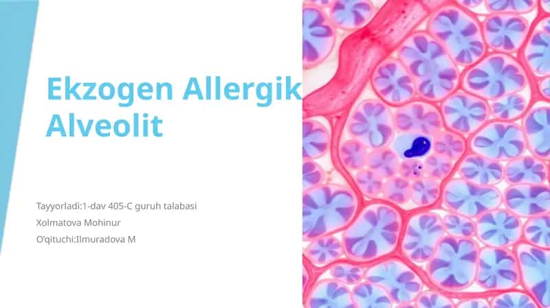EkzogenAllergikAlveolit 1
