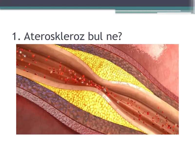 Ateroskleroz 1