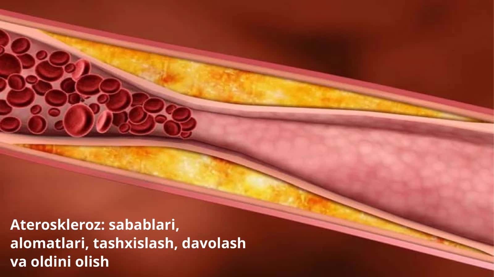 Ateroskleroz: sabablari, alomatlari, tashxislash, davolash va oldini olish 1