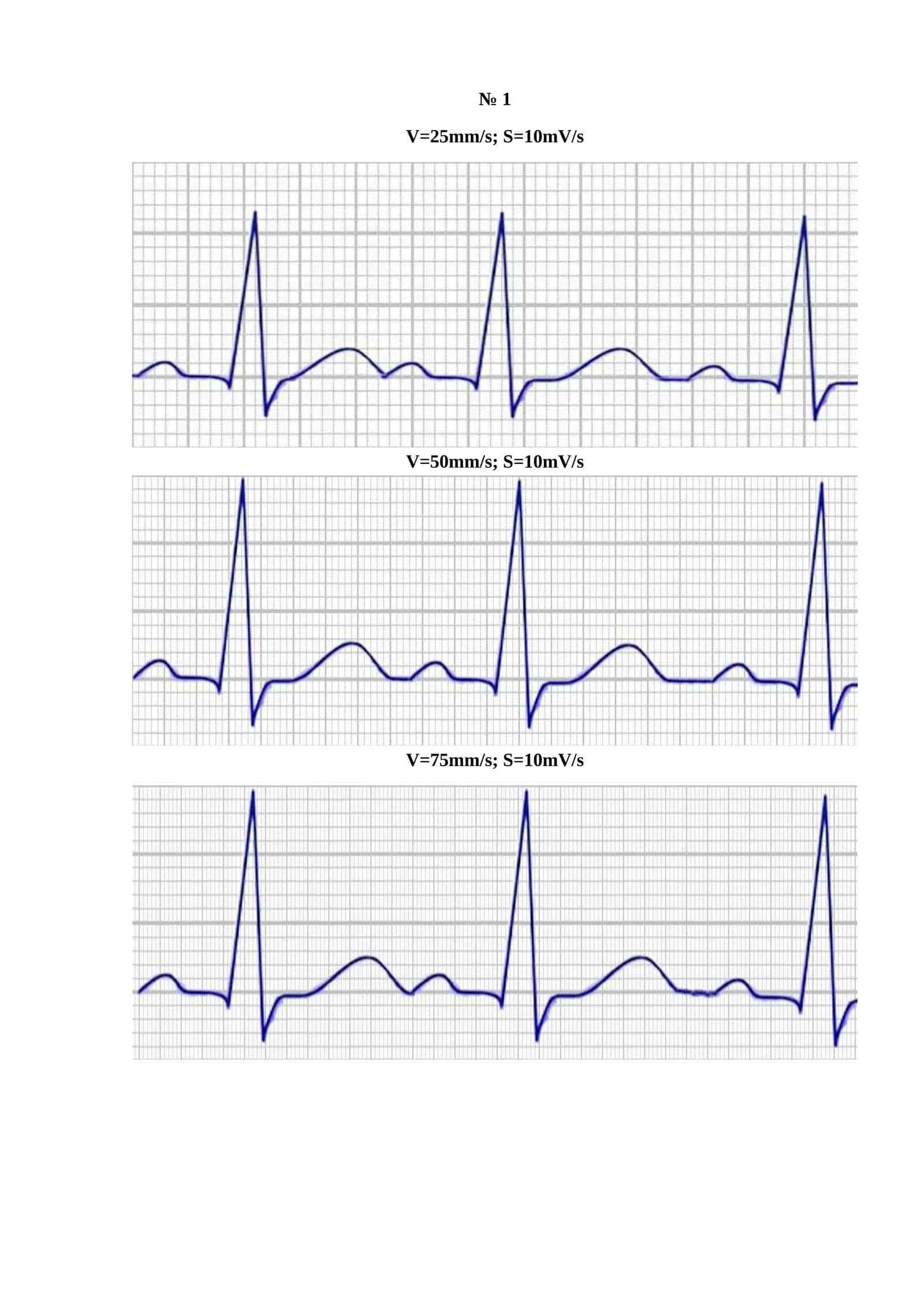 V=25mm/s; S=10mV/s 1