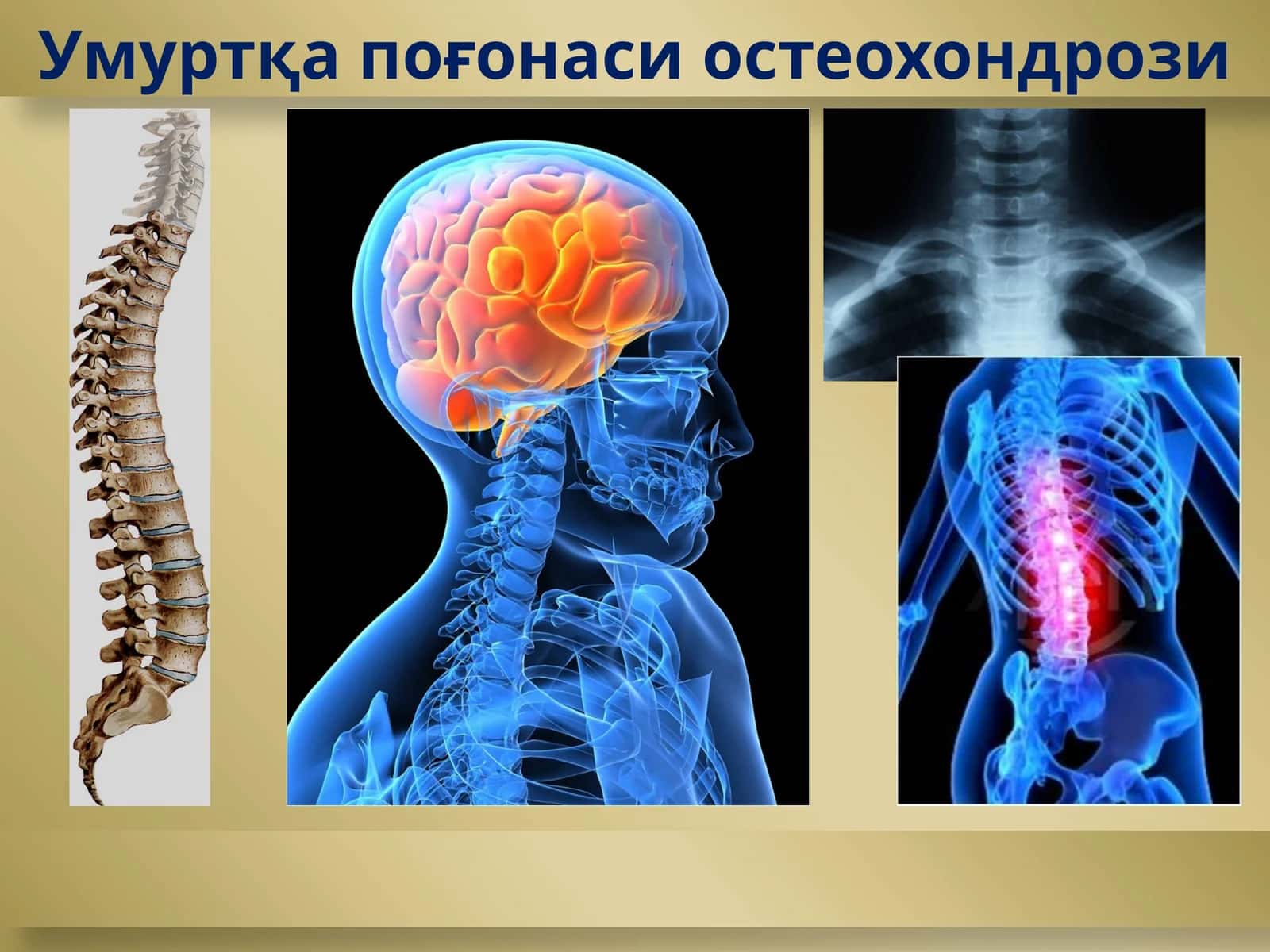 Умуртқа поғонаси остеохондрози 1