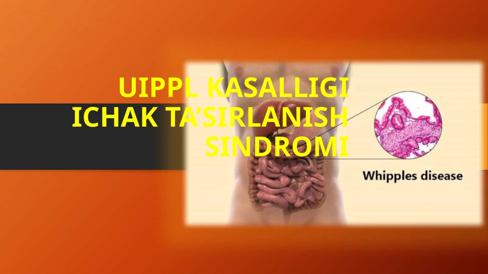 Uippl kasalligi va Ichak ta’sirlanish sindromi (ITS): etiologiya, diagnostika va davolash 1
