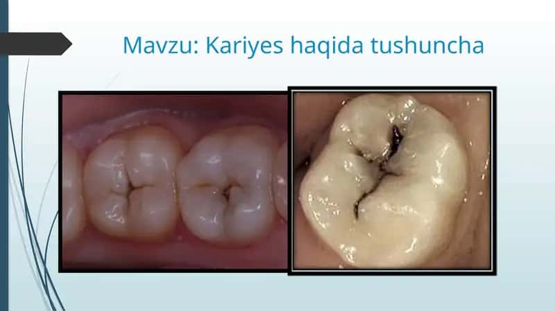 Kariyes haqida tushuncha 1