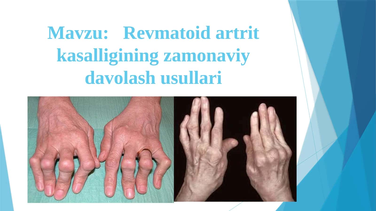 Revmatoidartritkasalligining zamonaviy davolash usullari 1