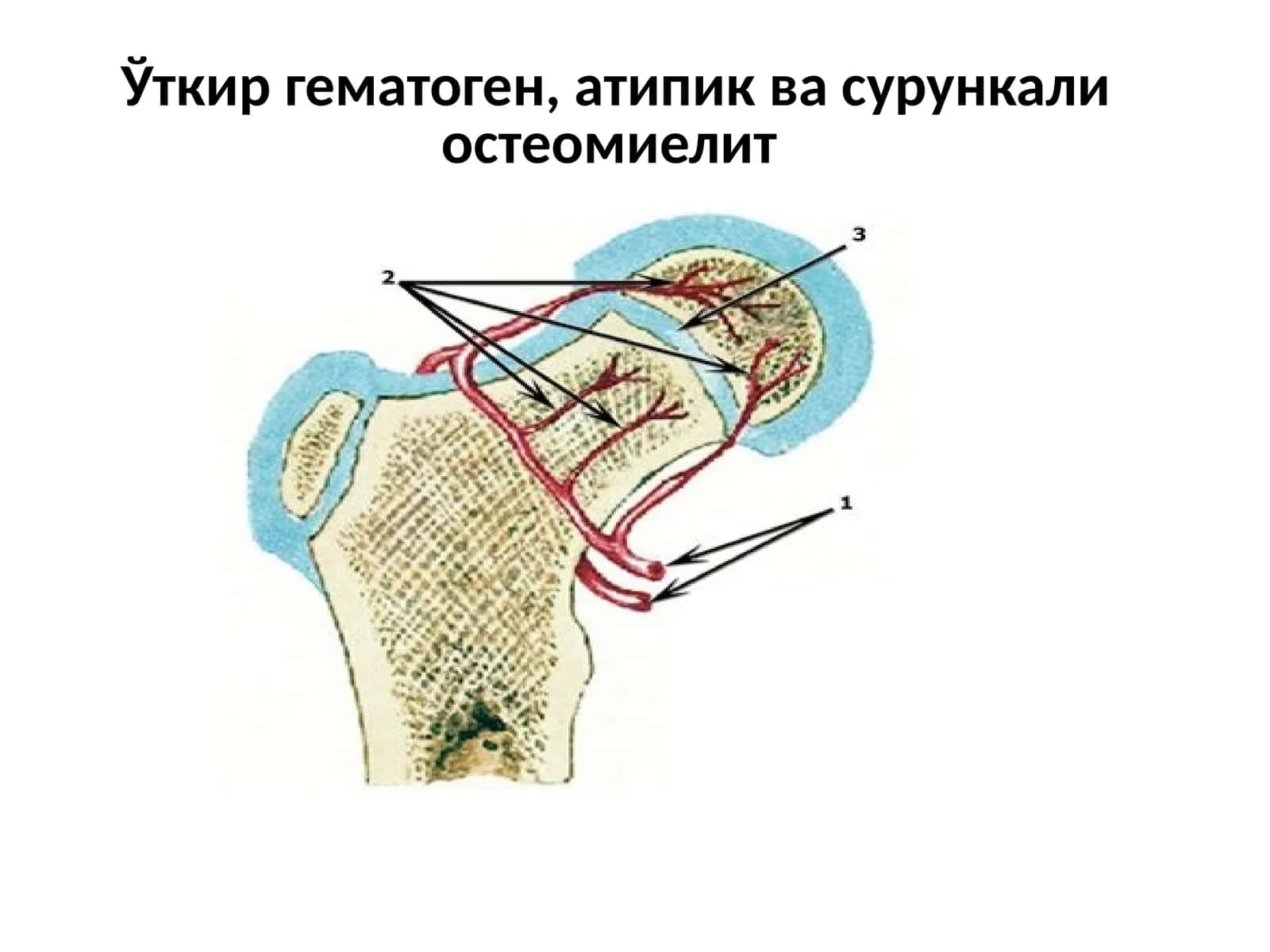 Уткир гематоген, атипик ва сурункали остеомиелитv - osteomiyelit 1