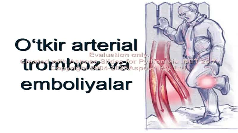 O‘tkir arterial tromboz va emboliyalar 1
