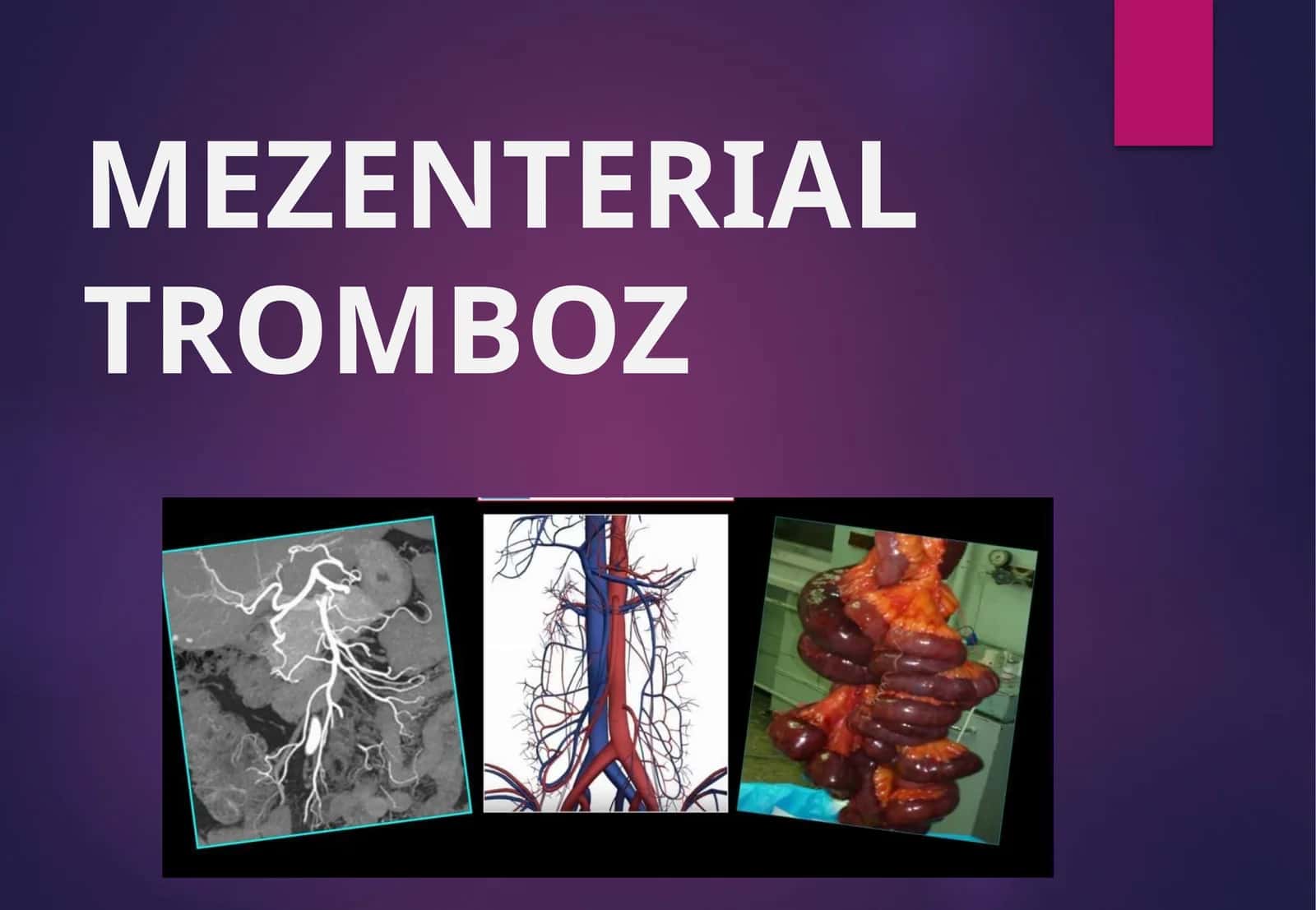MEZENTERIAL TROMBOZ 1