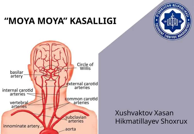 "Moyamoya"kasalligi 1