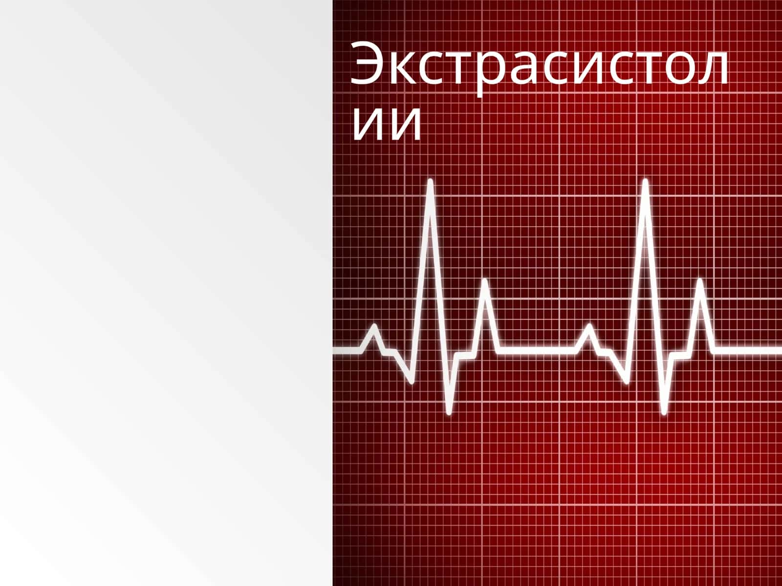 Экстрасистолия 1