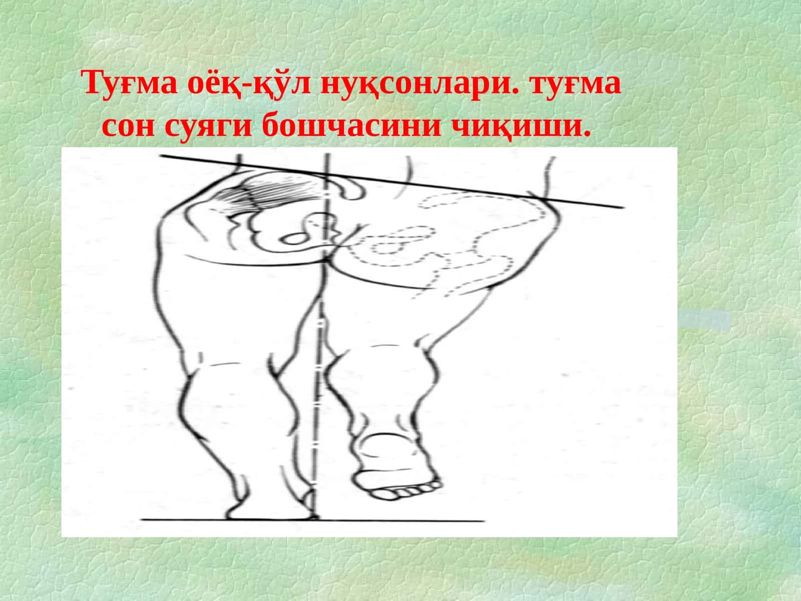 Симптом Барлоу 1