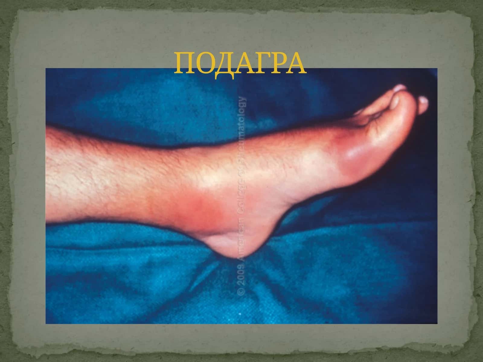 Подагра 1