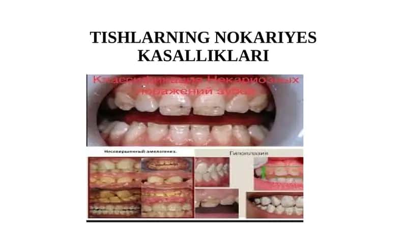 TISHLARNING NOKARIYES KASALLIKLARI 1