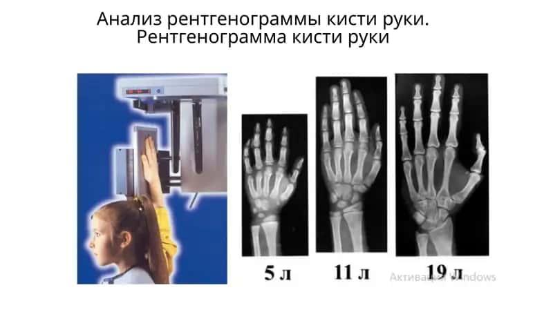 Рентгенограмма кисти руки 1