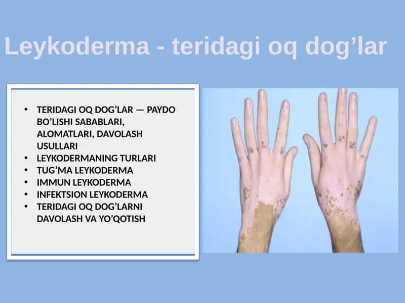 Leykoderma - teridagi oq dog’lar 1