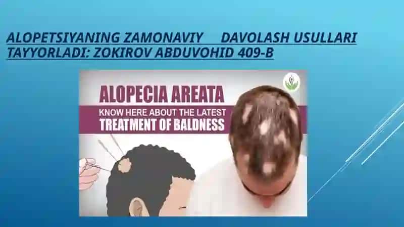 ALOPETSIYANING ZAMONAVIY DAVOLASH USULLARI