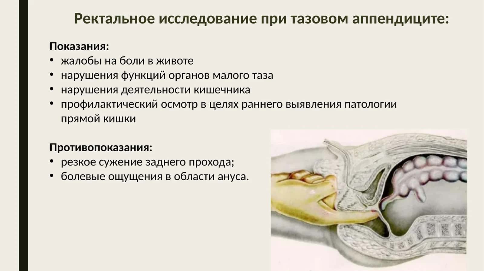 Ректальное исследование при тазовом аппендиците 1