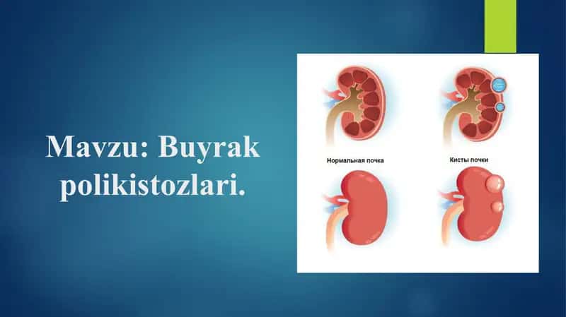 Buyrakpolikistozlari 1