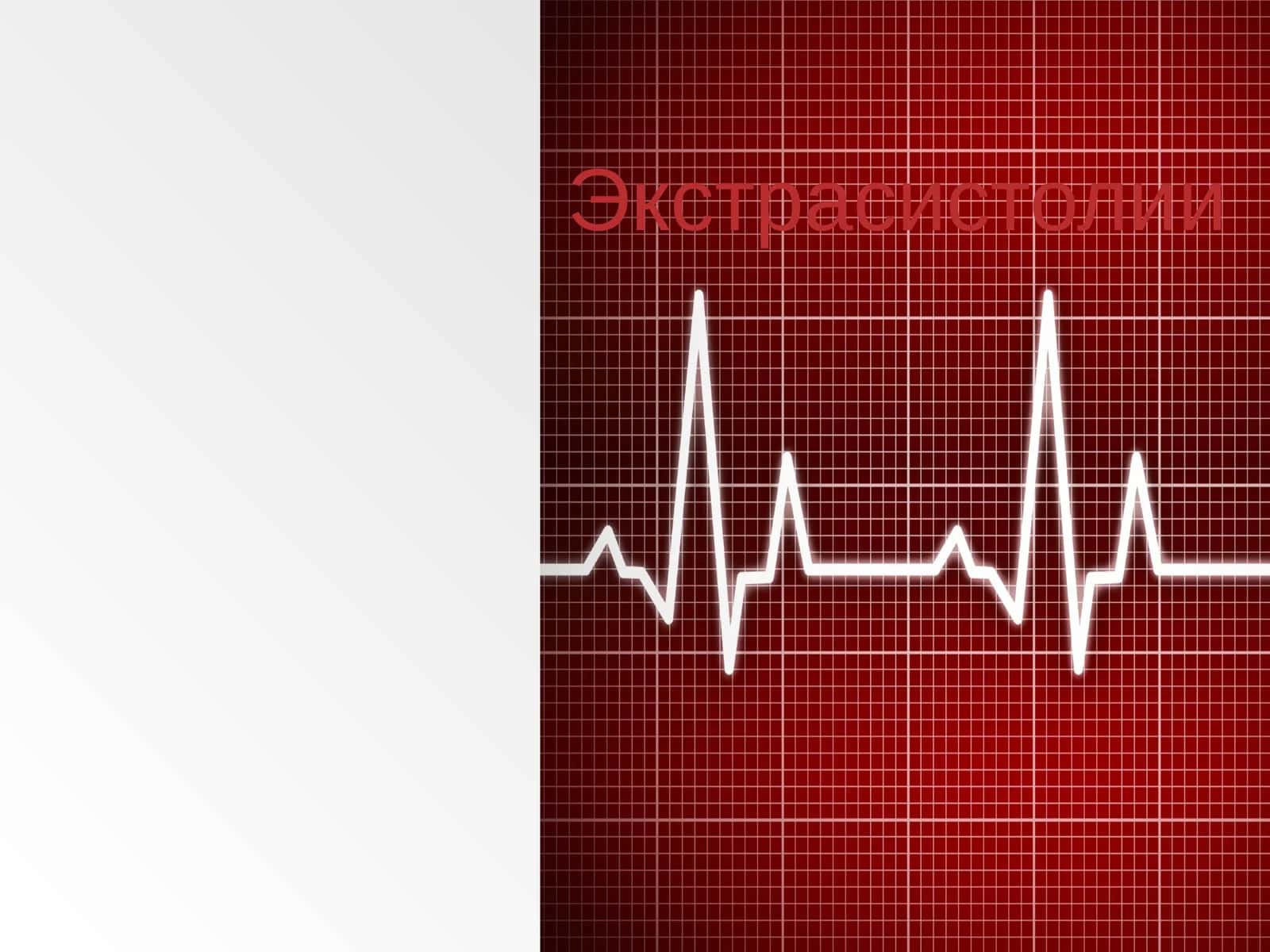 Экстрасистолии 1