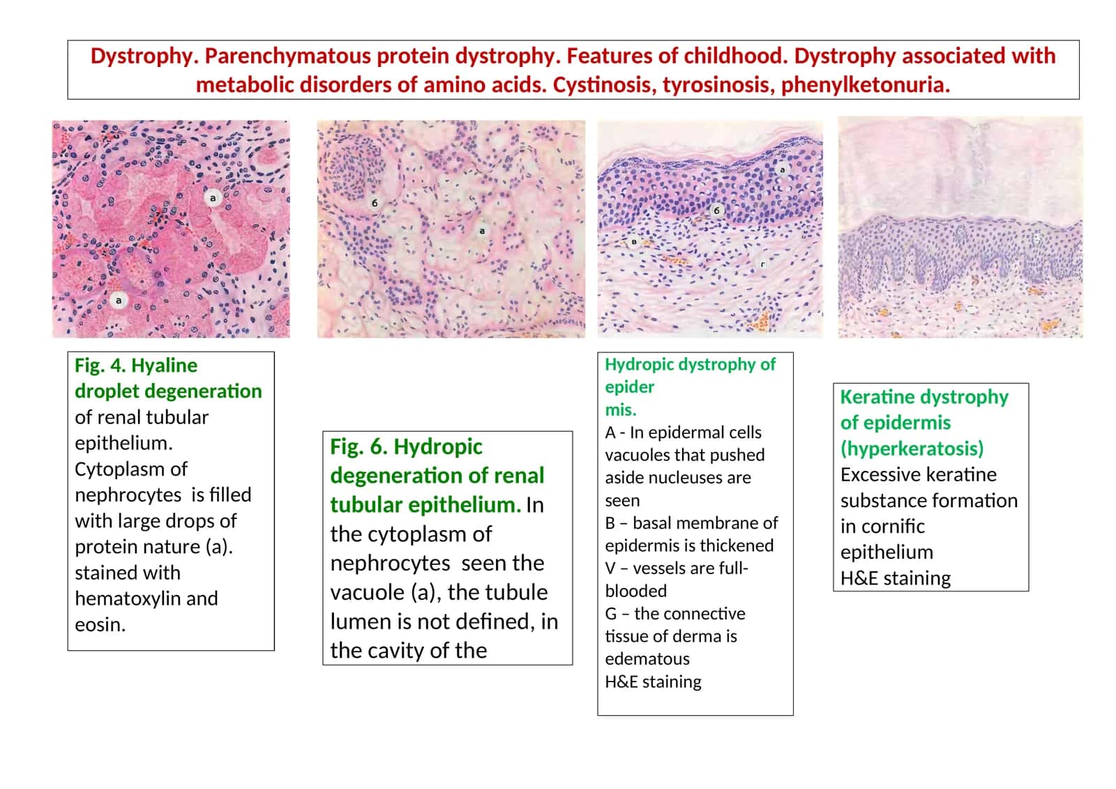 Hydropic dystrophy of epidermis 1