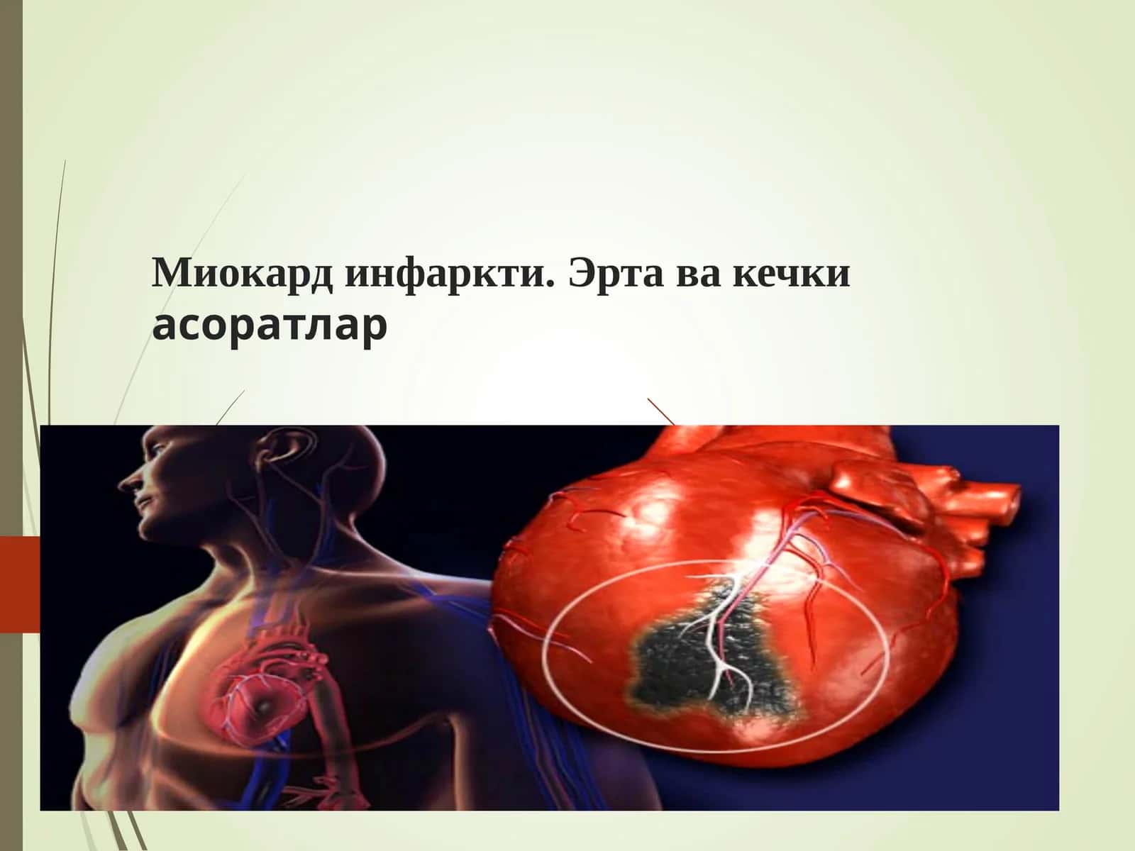 Миокард инфаркти. Эрта ва кечки асоратлар 1
