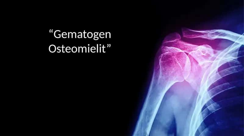 Gematogen osteomiyelit mustaqil ish  . tibbiyot 1