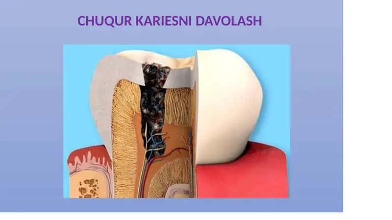 CHUQUR KARIESNI DAVOLASH 1