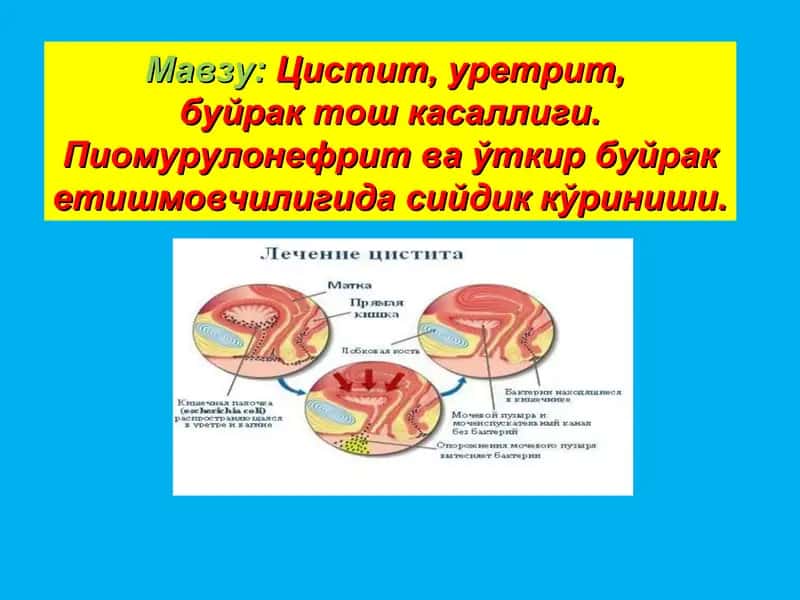 Цистит, уретрит,сурункали буйракетишмовчилиги 1