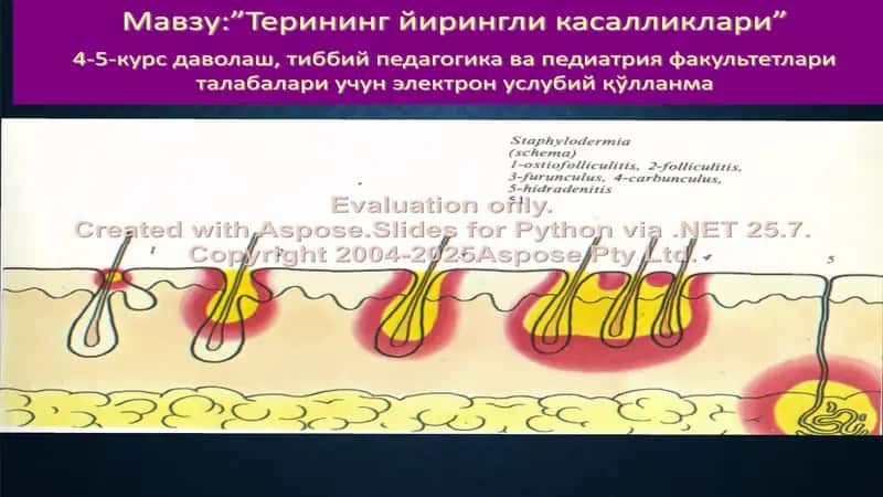 Терининг йирингли касалликлари (Пиодермитлар) электрон услубий қўлланма 1