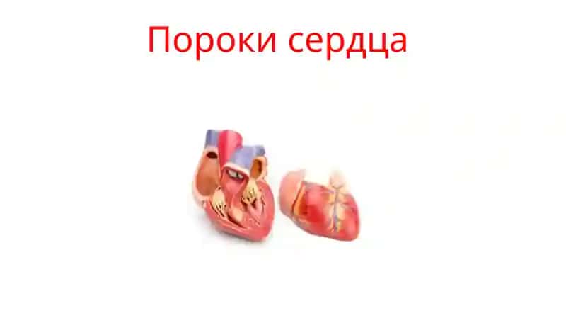 пороки сердца