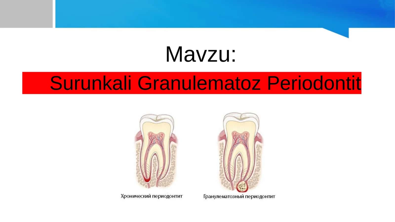 Surunkali granulematoz periodontit 1