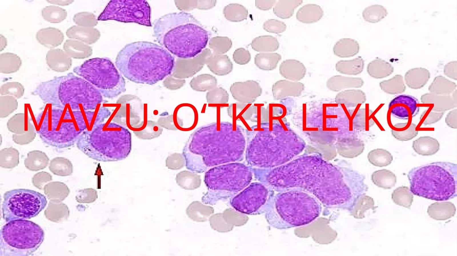 O‘TKIR LEYKOZ 1
