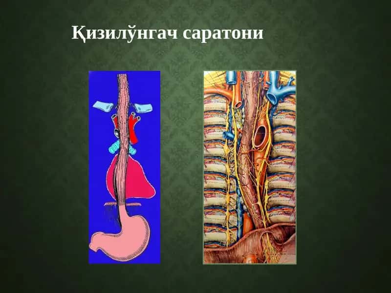 Қизилўнгач саратони 1
