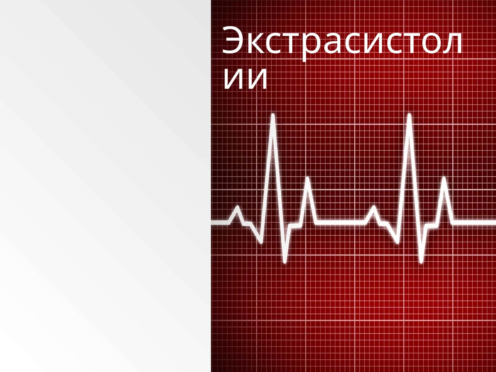 Экстрасистолии 1